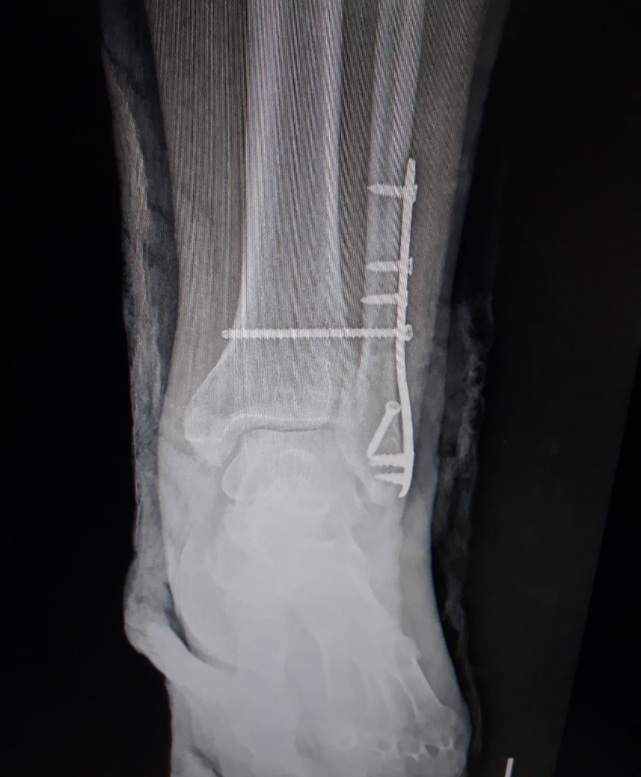 Distal-Fibula-12