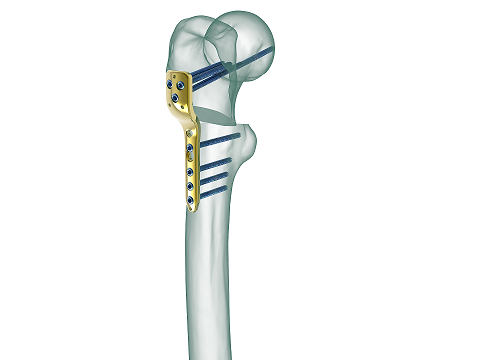 pediatrik-femur.13sdf9