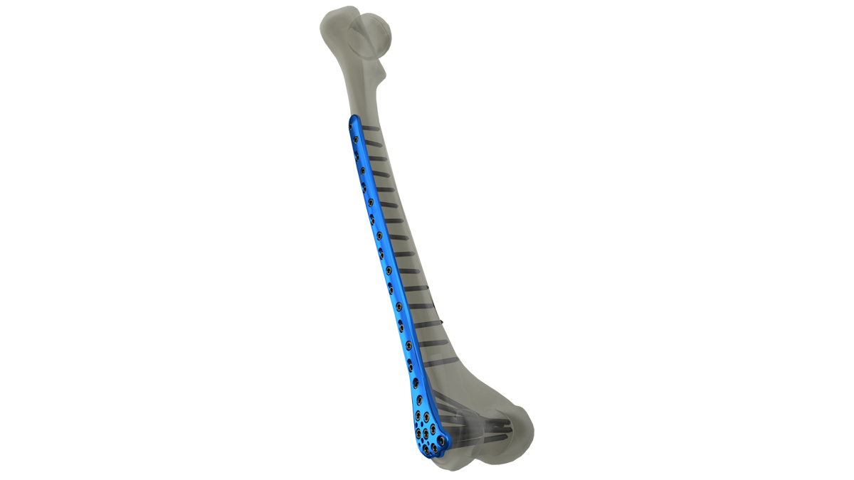 Product-_CNL-Distal-Femur-Lateral