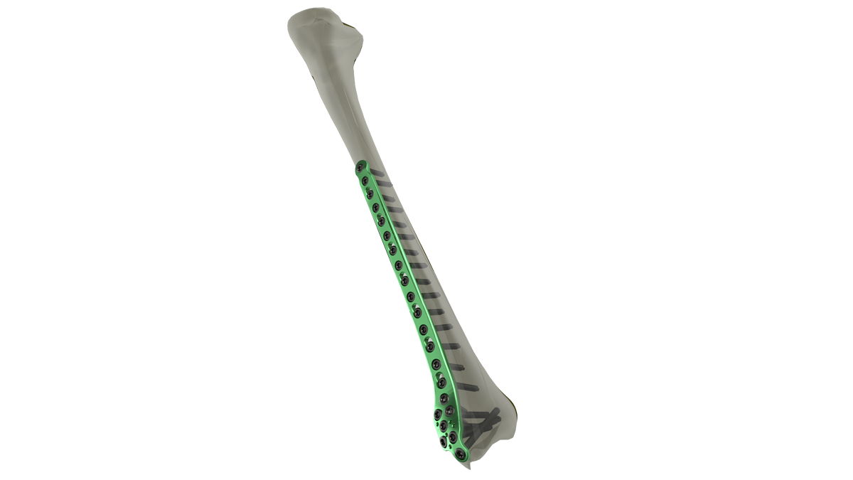 Product-_CNL-Distal-Tibia-Medial